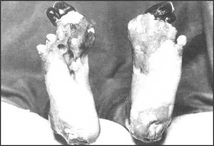A photograph of a man suffering from trench foot