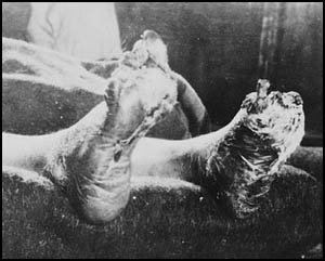 Trench Foot and the First World War